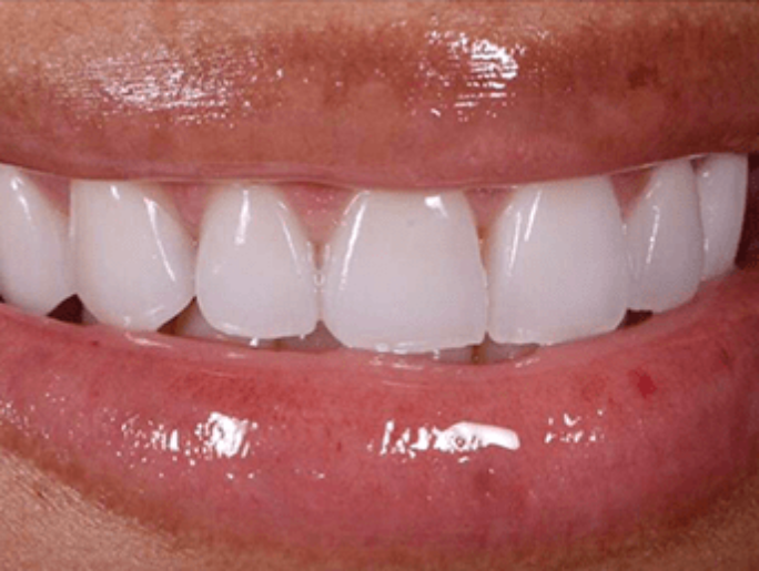 After Sutton Aesthetic Dentistry