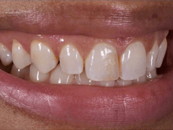 Before Sutton Aesthetic Dentistry