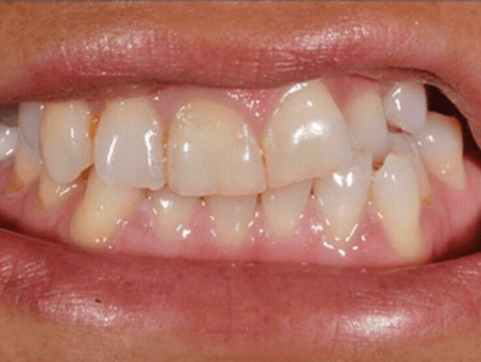 Before Sutton Aesthetic Dentistry