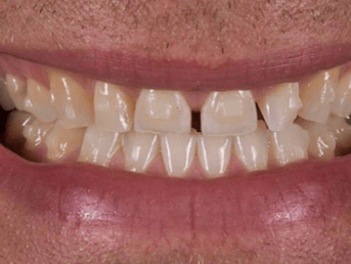 Before Sutton Aesthetic Dentistry