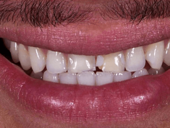 Before Sutton Aesthetic Dentistry