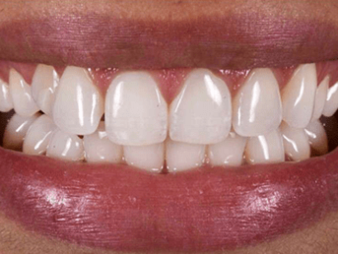 Before Sutton Aesthetic Dentistry