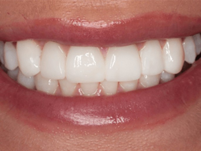 After Sutton Aesthetic Dentistry