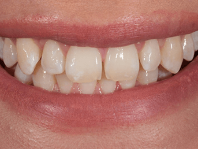 Before Sutton Aesthetic Dentistry