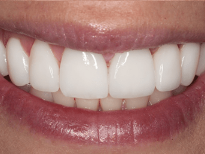 After Sutton Aesthetic Dentistry