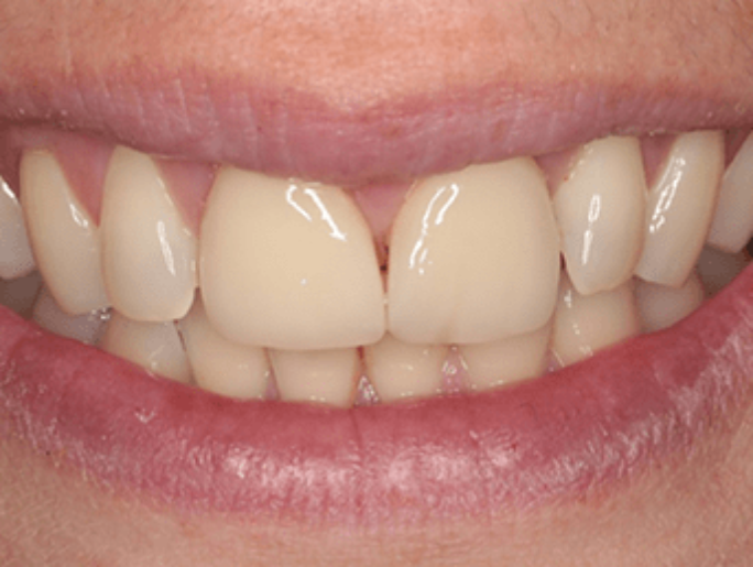 Before Sutton Aesthetic Dentistry