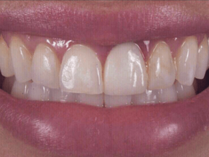 Before Sutton Aesthetic Dentistry