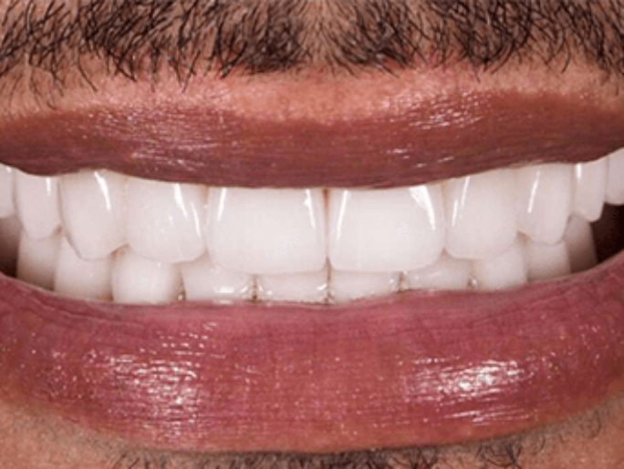 After Sutton Aesthetic Dentistry