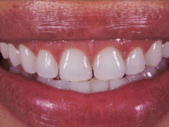 Before Sutton Aesthetic Dentistry