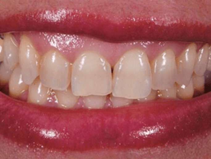 Before Sutton Aesthetic Dentistry