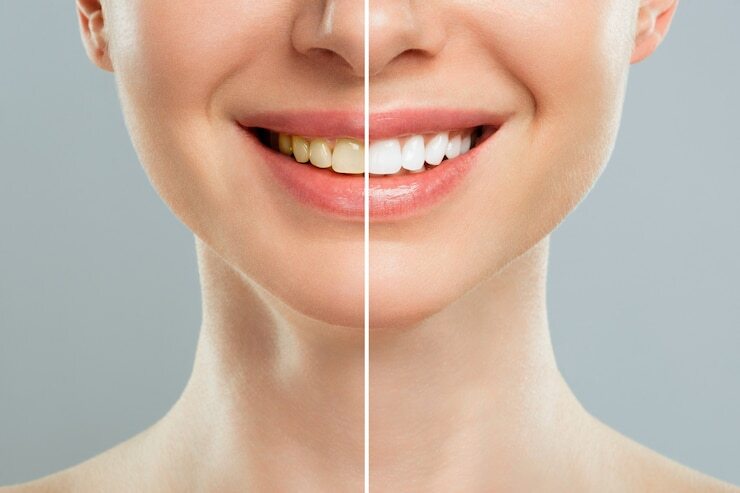 The Step-by-Step Process of Teeth Bonding: What to Expect