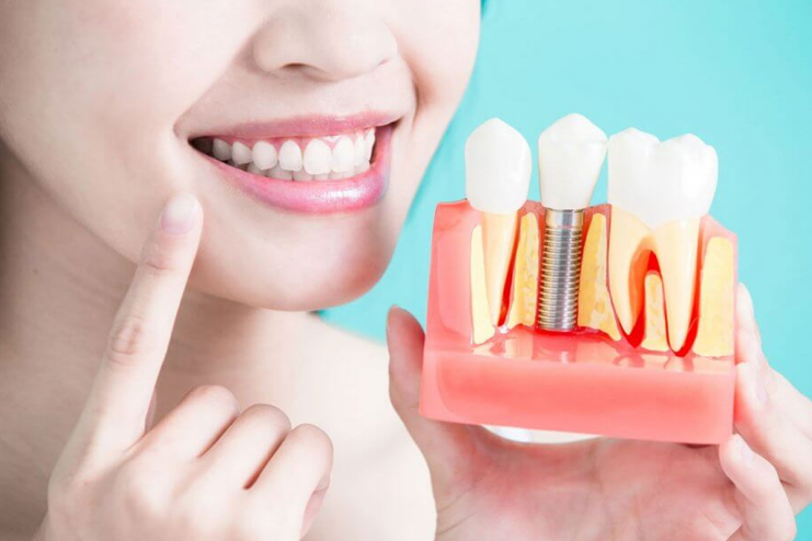 Birmingham Dental Implants