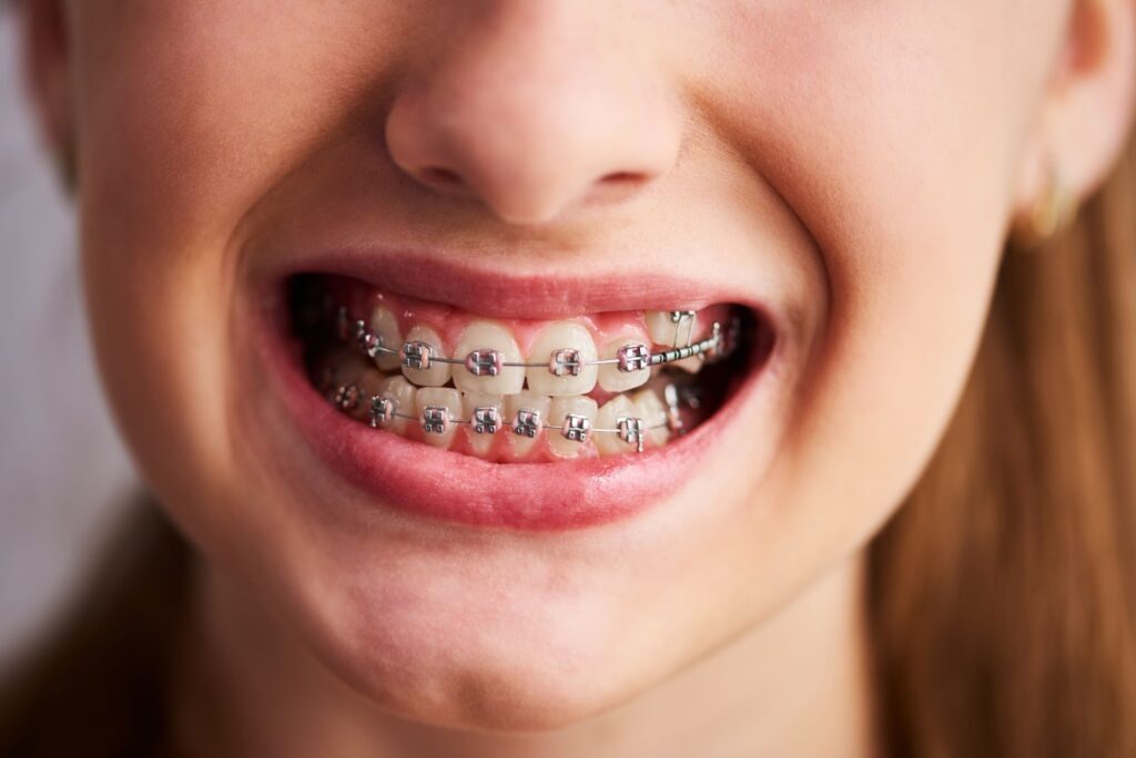 Ceramic Braces For Teeth