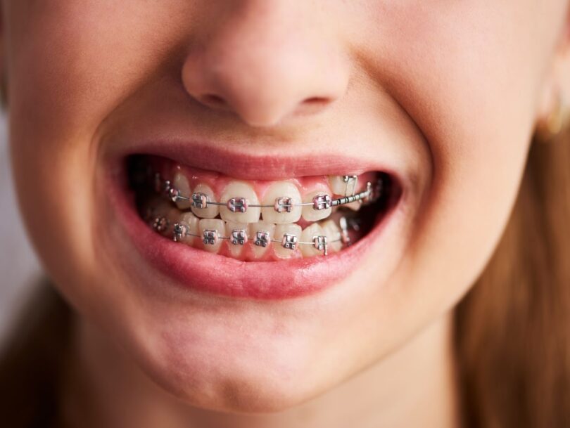Ceramic Braces For Teeth