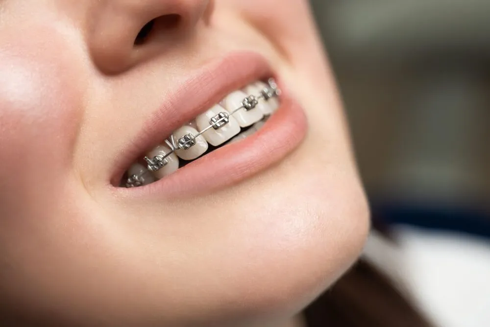 Braces For Smile Makeover