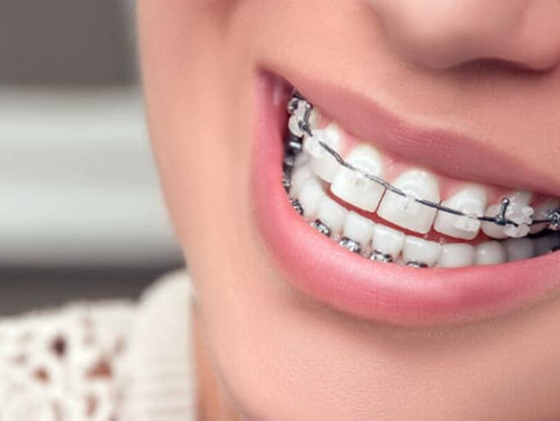 Cerec Braces In Birmingham