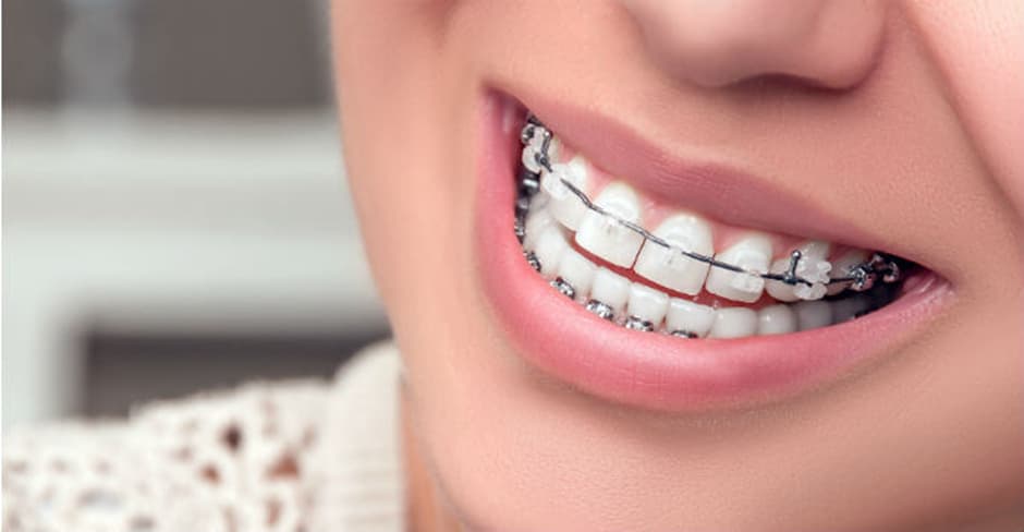 Cerec Braces In Birmingham