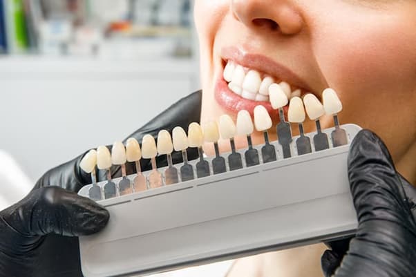 Porcelain Veneers for Teeth