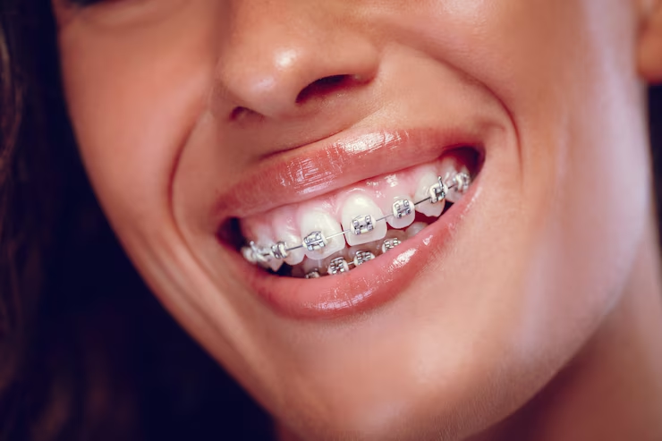 Ceramic Braces Birmingham