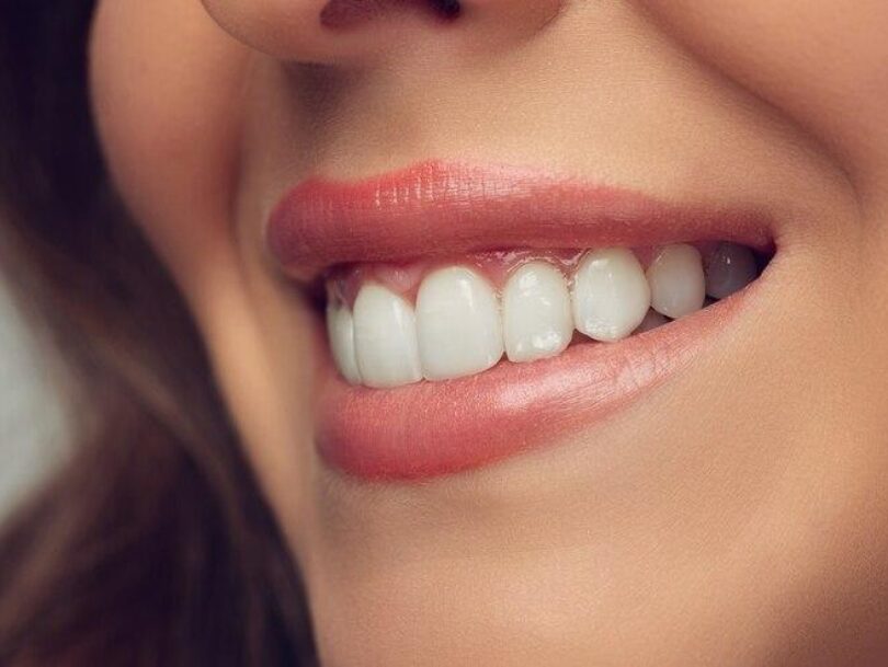Teeth Whitening