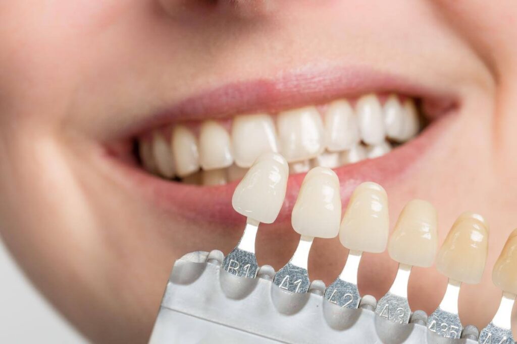 dental veneers in birmingham