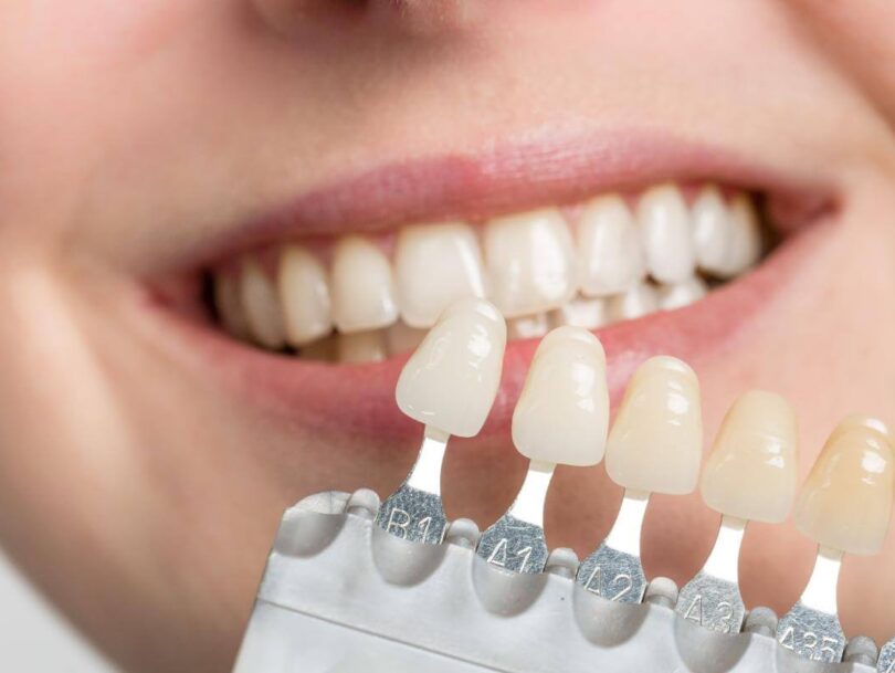 dental veneers in birmingham