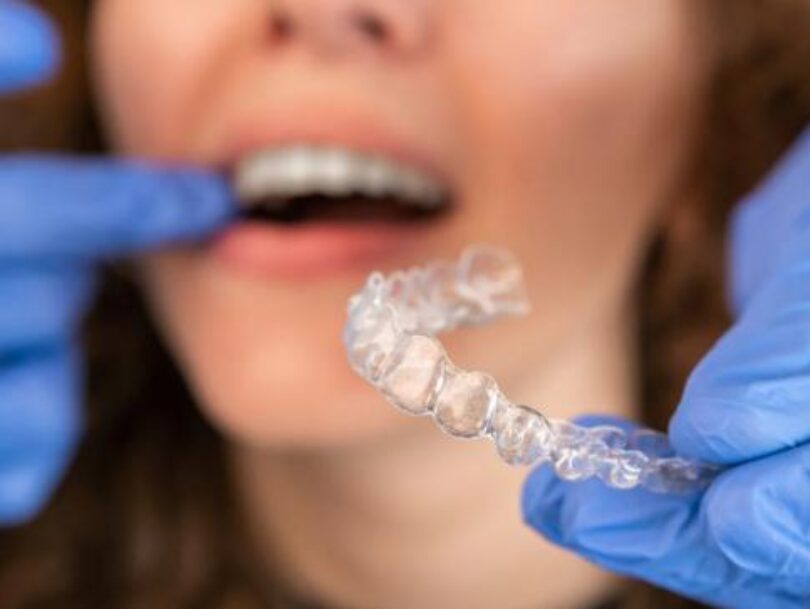 birmingham Ceramic Braces