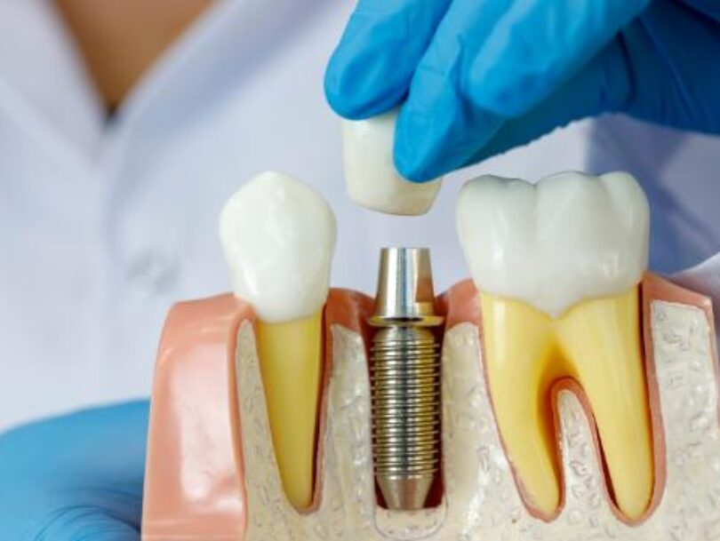 Dental implants Clinic In Bermingham