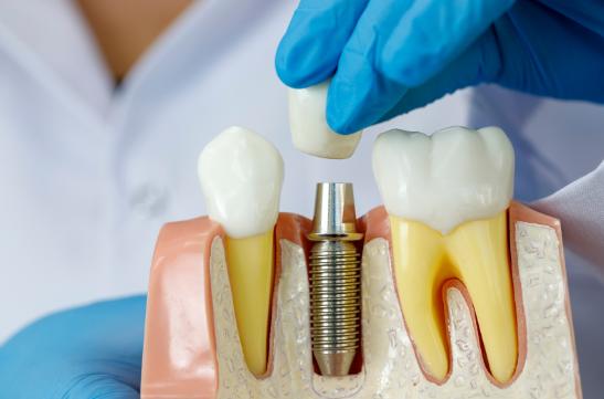 Dental implants Clinic In Bermingham