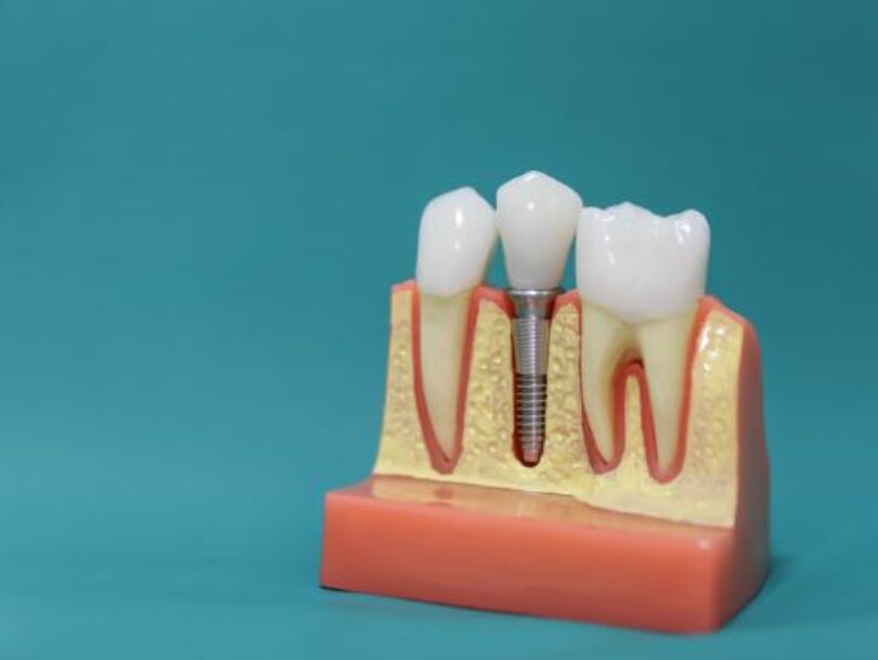 dental implants