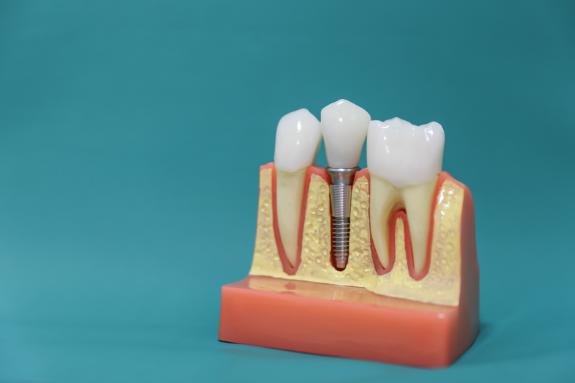 dental implants