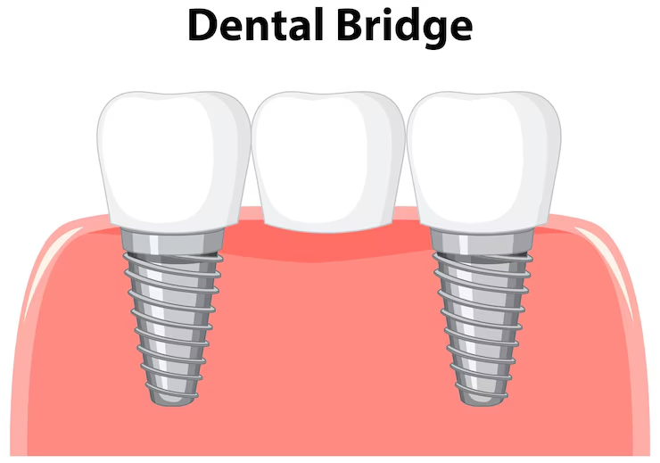 Dental Bridges Cost UK