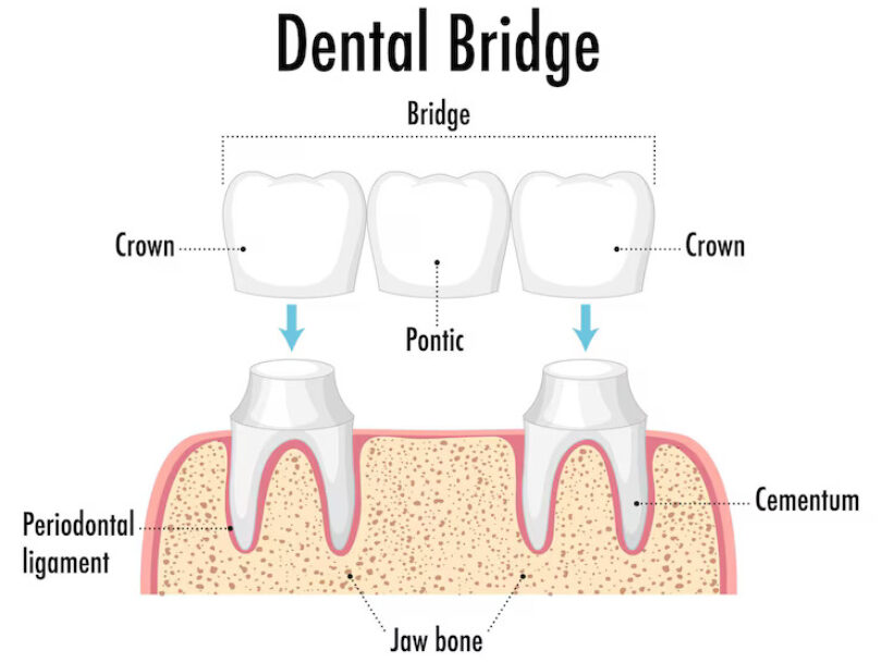 Dental Bridge In UK