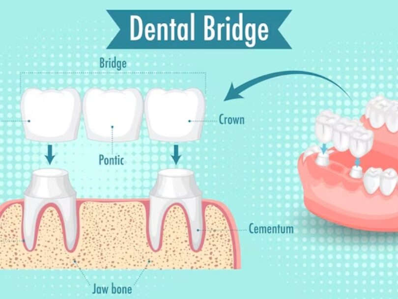 Fixed Dental Bridge