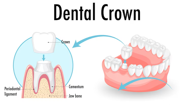Dental Crown Repair
