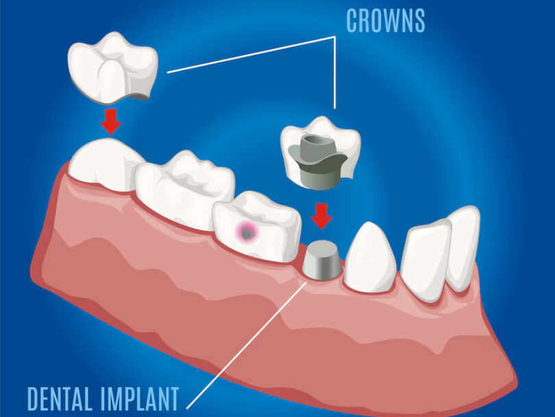 Crown Dental Surgery
