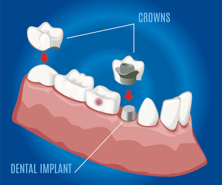 Crown Dental Surgery